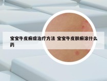 宝宝牛皮癣症治疗方法 宝宝牛皮肤癣涂什么药