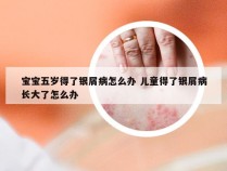 宝宝五岁得了银屑病怎么办 儿童得了银屑病长大了怎么办