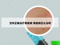 怎样正确治疗银翘病 银翘病怎么治啊