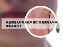 银屑病什么时候才能不发红 银屑病什么时候才能不发红了