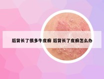 后背长了很多牛皮癣 后背长了皮癣怎么办