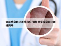 银屑病白斑还用擦药吗 银屑病变成白斑还用抹药吗