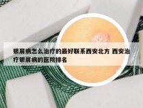 银屑病怎么治疗的最好联系西安北方 西安治疗银屑病的医院排名