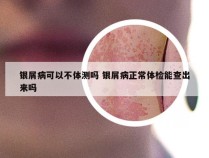 银屑病可以不体测吗 银屑病正常体检能查出来吗