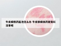 牛皮癣擦药起泡怎么办 牛皮肤癣抹药就变红没事吧