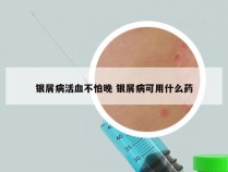 银屑病活血不怕晚 银屑病可用什么药