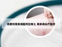 我要找银屑病医院在哪儿 银屑病治疗医院