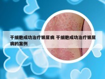 干细胞成功治疗银屑病 干细胞成功治疗银屑病的案例