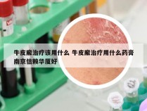 牛皮廨治疗该用什么 牛皮廨治疗用什么药膏南京信赖华厦好