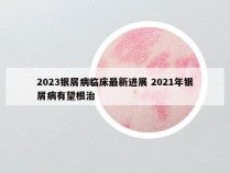 2023银屑病临床最新进展 2021年银屑病有望根治