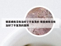 银屑病有没有治好了不复发的 银屑病有没有治好了不复发的案例