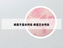 癣是不是会传染 癣是否会传染