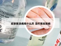 皮肤银消病用什么药 治疗银皮肤癣