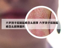 六岁孩子后腿起癣怎么回事 六岁孩子后腿起癣怎么回事图片