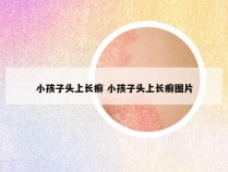 小孩子头上长癣 小孩子头上长癣图片