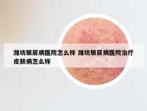 潍坊银屑病医院怎么样 潍坊银屑病医院治疗皮肤病怎么样