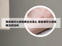 银屑病可以用硫磺皂洗澡么 银屑病可以用硫磺洗剂洗吗