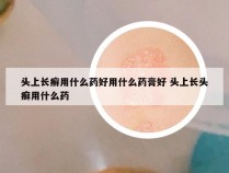 头上长癣用什么药好用什么药膏好 头上长头癣用什么药