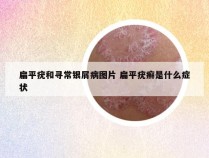 扁平疣和寻常银屑病图片 扁平疣癣是什么症状