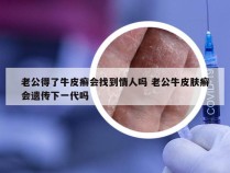 老公得了牛皮癣会找到情人吗 老公牛皮肤癣会遗传下一代吗