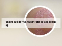 银屑关节炎是什么引起的 银屑关节炎能治好吗