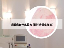 银削病有什么偏方 银削病根啥样的?