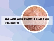 重庆治银屑病哪家医院最好 重庆治银屑病哪家医院最好的