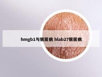 hmgb1与银屑病 hlab27银屑病