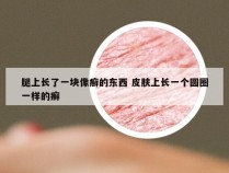 腿上长了一块像癣的东西 皮肤上长一个圆圈一样的癣