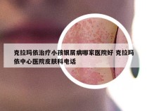 克拉玛依治疗小孩银屑病哪家医院好 克拉玛依中心医院皮肤科电话