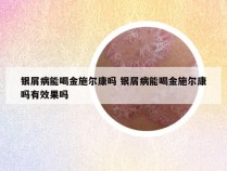 银屑病能喝金施尔康吗 银屑病能喝金施尔康吗有效果吗