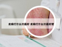 皮癣打什么针最好 皮癣打什么针最好使