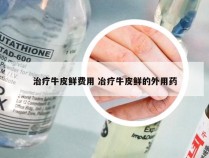 治疗牛皮鲜费用 冶疗牛皮鲜的外用药