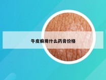 牛皮癣用什么药膏价格