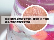 目前治疗银屑病最安全最好的医院 治疗银屑病最权威的医院专家是谁