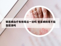 银屑病治疗有排毒这一说吗 银屑病排毒不能靠尿液吗