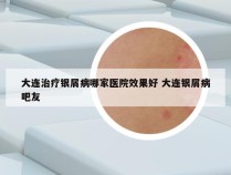 大连治疗银屑病哪家医院效果好 大连银屑病吧友