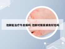 泡脚能治疗牛皮癣吗 泡脚对银屑病有好处吗