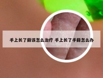 手上长了藓该怎么治疗 手上长了手藓怎么办