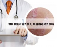 银屑病能不能去根儿 银屑病可以去根吗