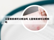 儿童银屑病可以根治吗 儿童银屑病可以断根吗