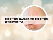 杭州治疗银屑病去哪家医院好 杭州治疗银屑病去哪家医院好点