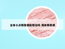 全身小点银屑病能根治吗 满身银屑病