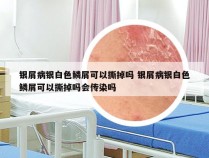 银屑病银白色鳞屑可以撕掉吗 银屑病银白色鳞屑可以撕掉吗会传染吗