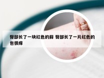 臀部长了一块红色的藓 臀部长了一片红色的包很痒