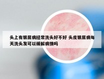 头上有银屑病经常洗头好不好 头皮银屑病每天洗头发可以缓解病情吗