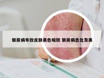 银屑病导致皮肤黑色暗斑 银屑病患处发黑