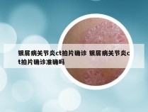 银屑病关节炎ct拍片确诊 银屑病关节炎ct拍片确诊准确吗