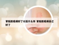 掌跖脓疱病好了以后什么样 掌跖脓疱病自己好了