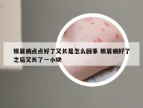 银屑病点点好了又长是怎么回事 银屑病好了之后又长了一小块